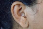 L'otite, un'infiammazione dell'orecchio che colpisce sia adulti che bambini